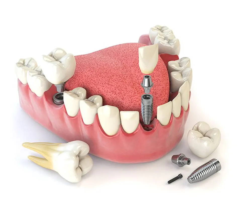 implant-dentaire-tunisie implant-dentaire-tunisie